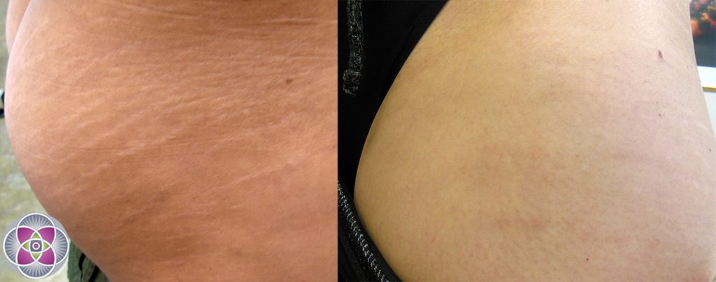 Information About Laser Stretch Marks Removal Spyware Removal Guideline